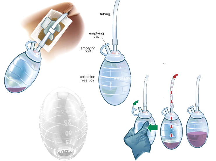 medical pressure ball for NPWT