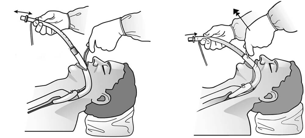 Silicone Laryngeal Mask Airway from China manufacturer - Better Silicone